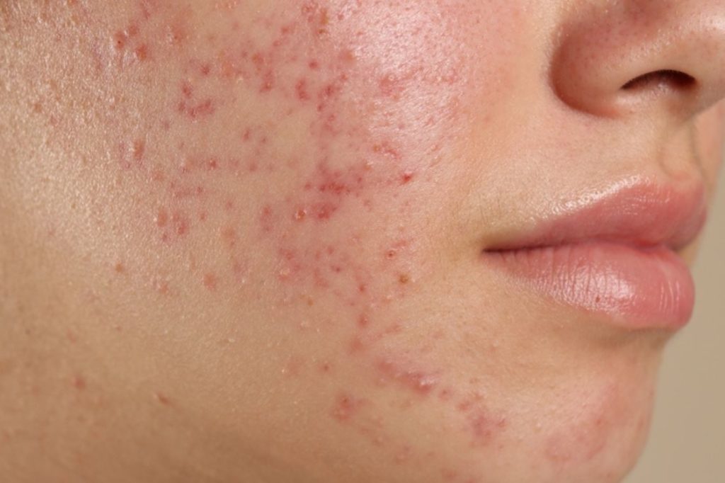 How to Spot the Difference Between Hormonal and Bacterial Acne